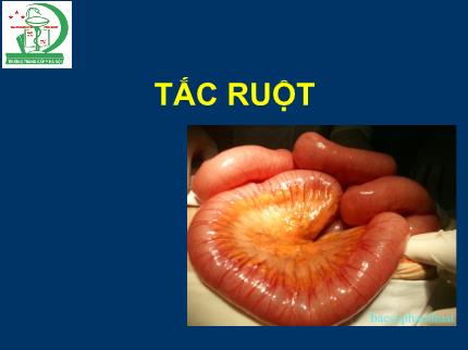Tìm hiểu bệnh Tắc ruột